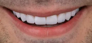 Depois - Diastema